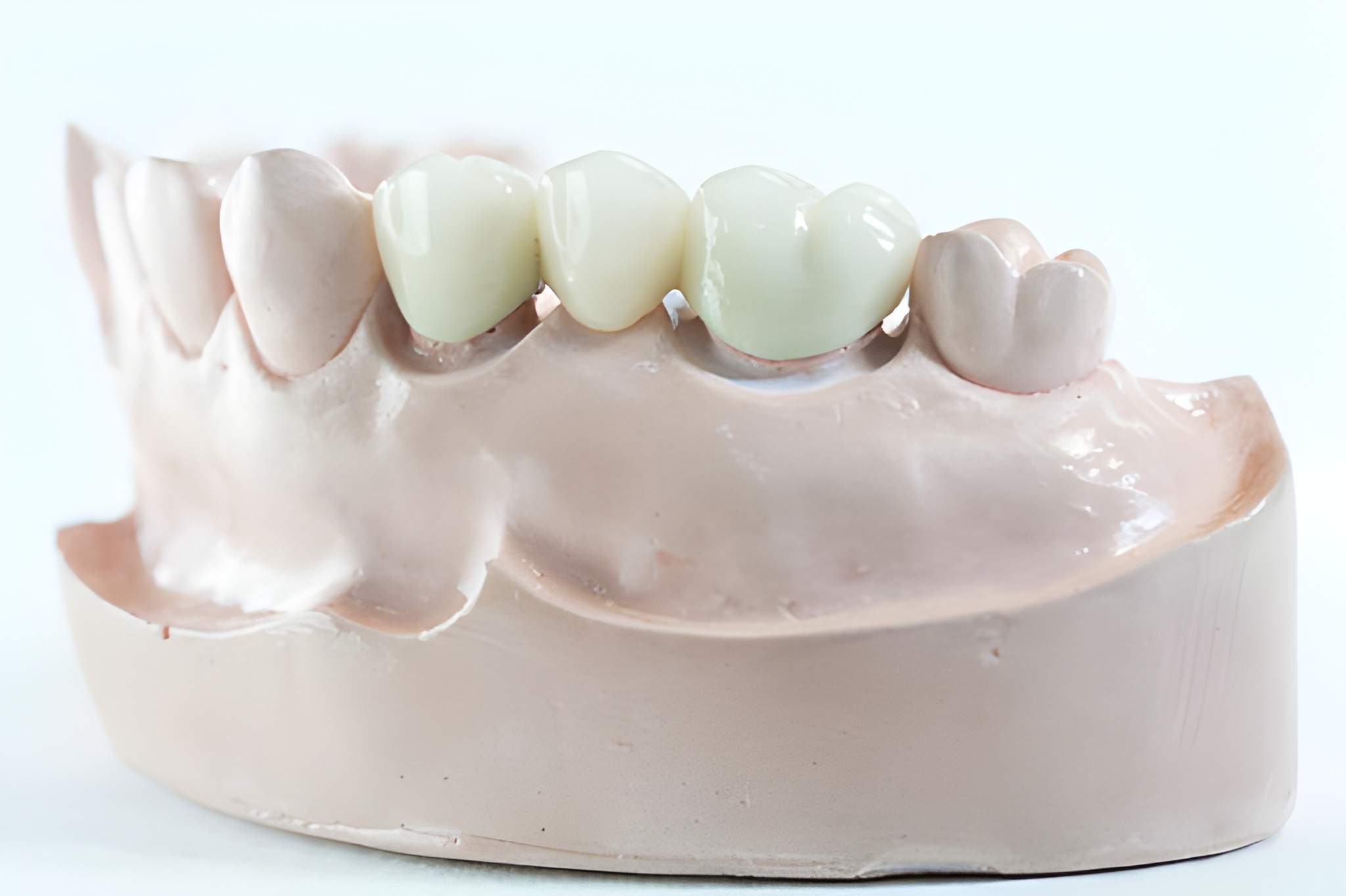 Dental Crowns in Montchanin, DE: Restore Your Smile with Garrett B. Lyons D.D.S., P.A._FI